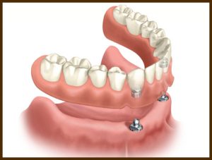 proteze dentare sector 2