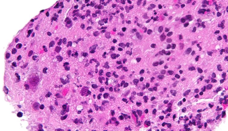 caracteristici Toxoplasmoza